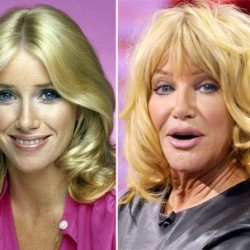 suzanne-somers-tv-stars-plastic-surgery